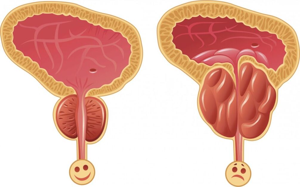 Symptoms of prostatitis in men